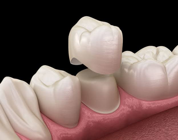 Dental Crowns treatment at Kripa Dental Clinic Bharatpur Chitwan