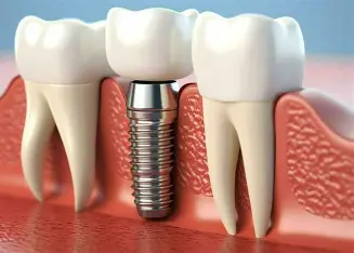 Dental Implants treatment at Kripa Dental Clinic Bharatpur Chitwan