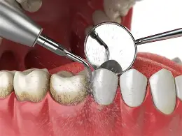 Teeth Cleaning & Scaling treatment at Kripa Dental Clinic Bharatpur Chitwan