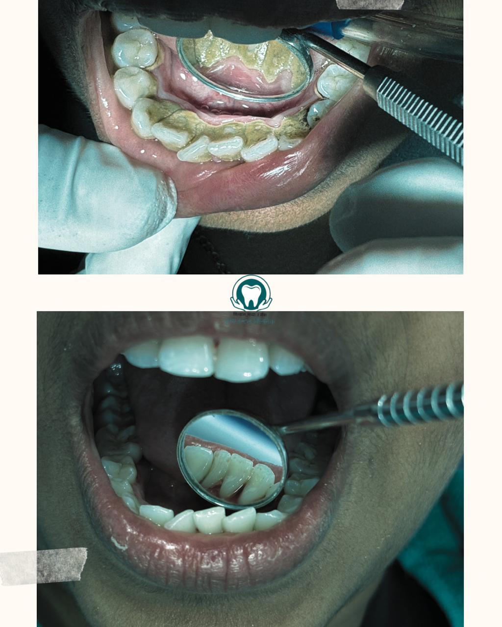 Smile transformation result at Kripa Dental Clinic Bharatpur