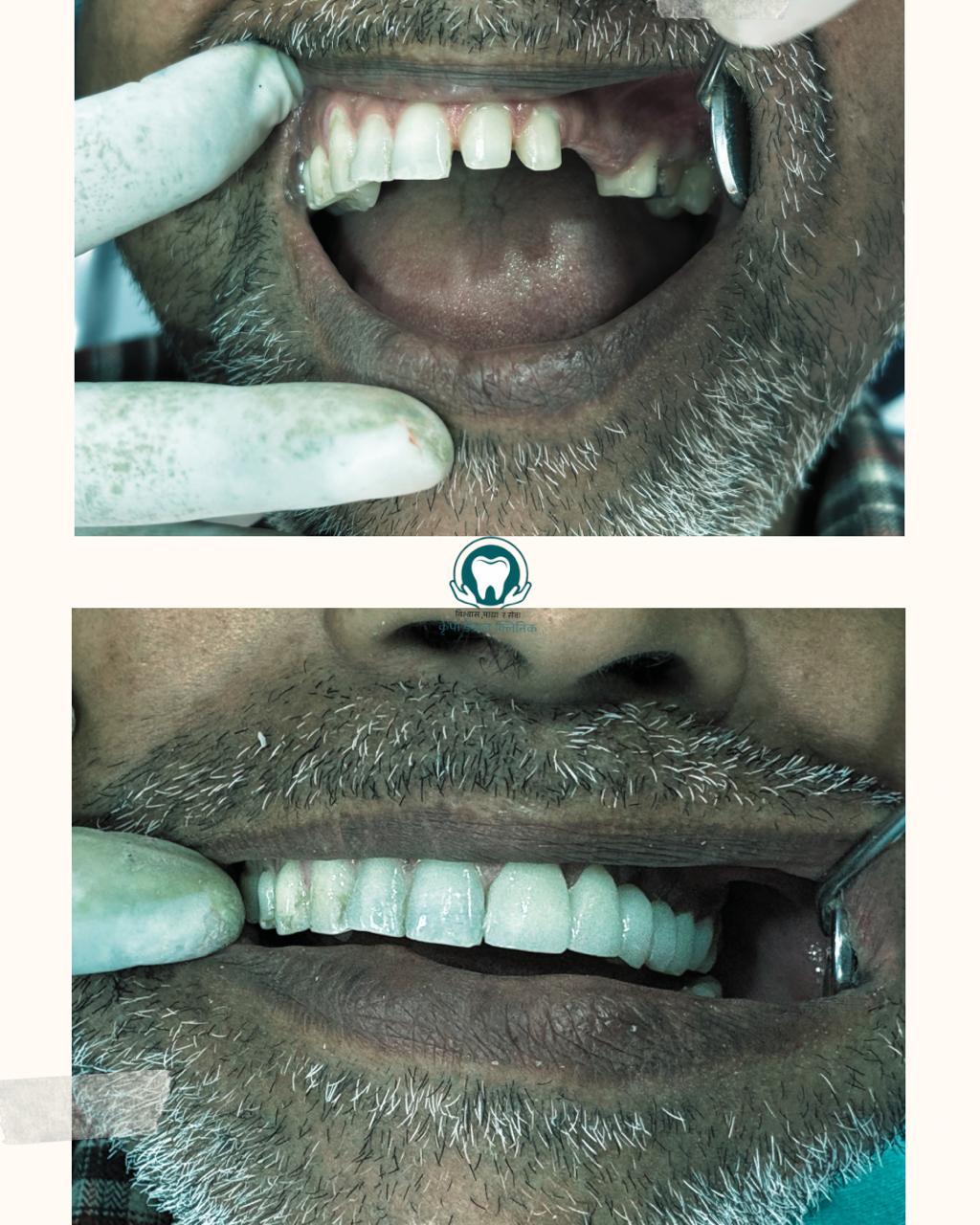 Smile transformation result at Kripa Dental Clinic Bharatpur