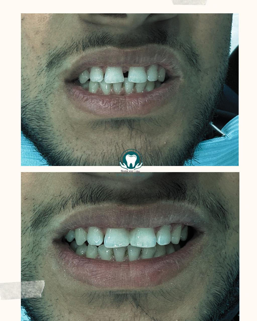 Smile transformation result at Kripa Dental Clinic Bharatpur