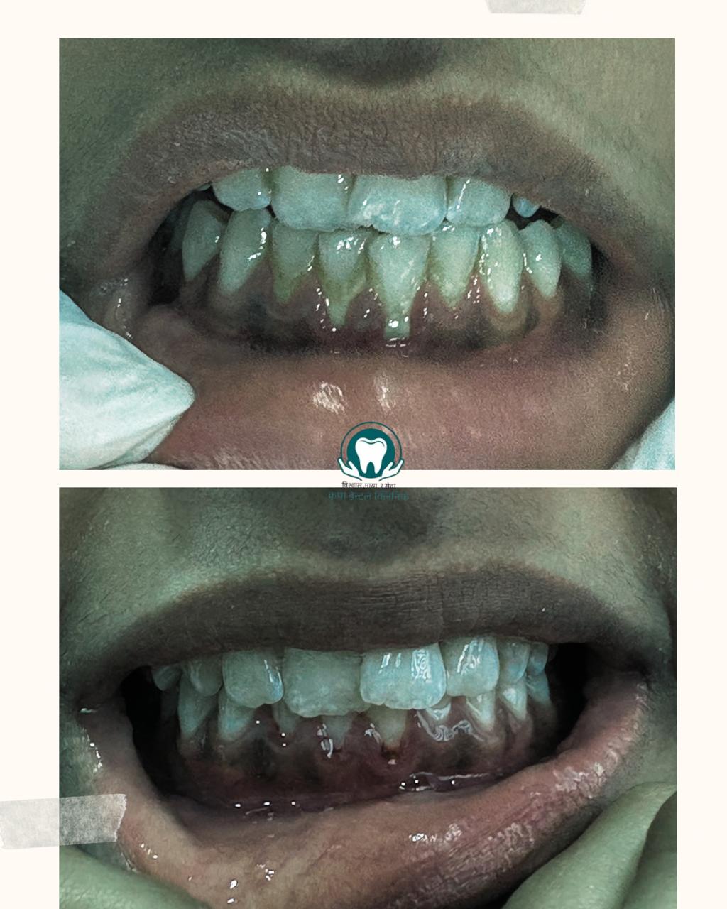 Smile transformation result at Kripa Dental Clinic Bharatpur